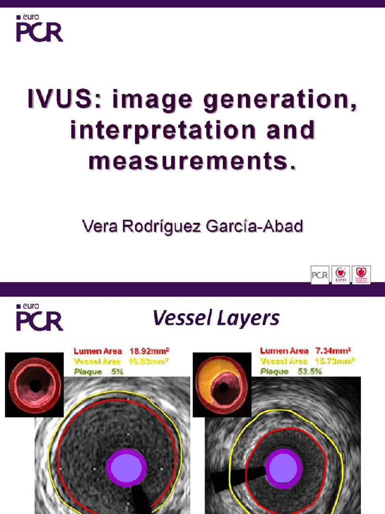 IVUS Image Generation Interpretation and Measurements | PDF