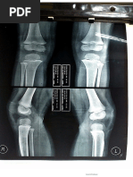Gustilo Classification of Open Fractures | PDF