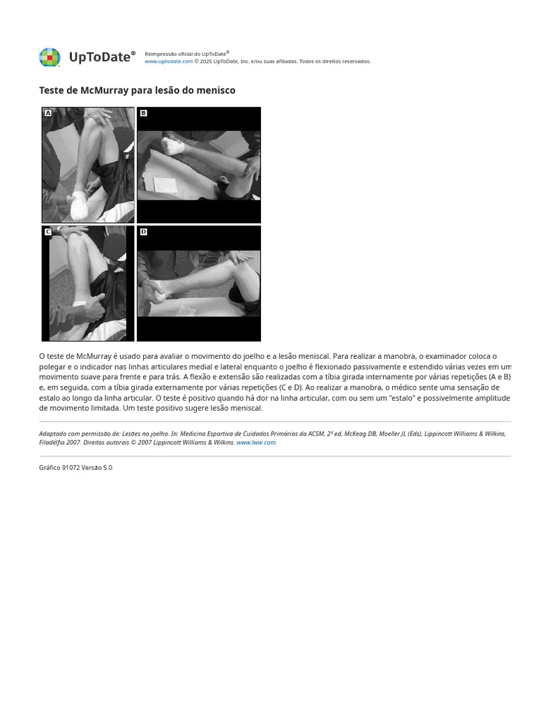 McMurray Test For Meniscus Injury - UpToDate | PDF