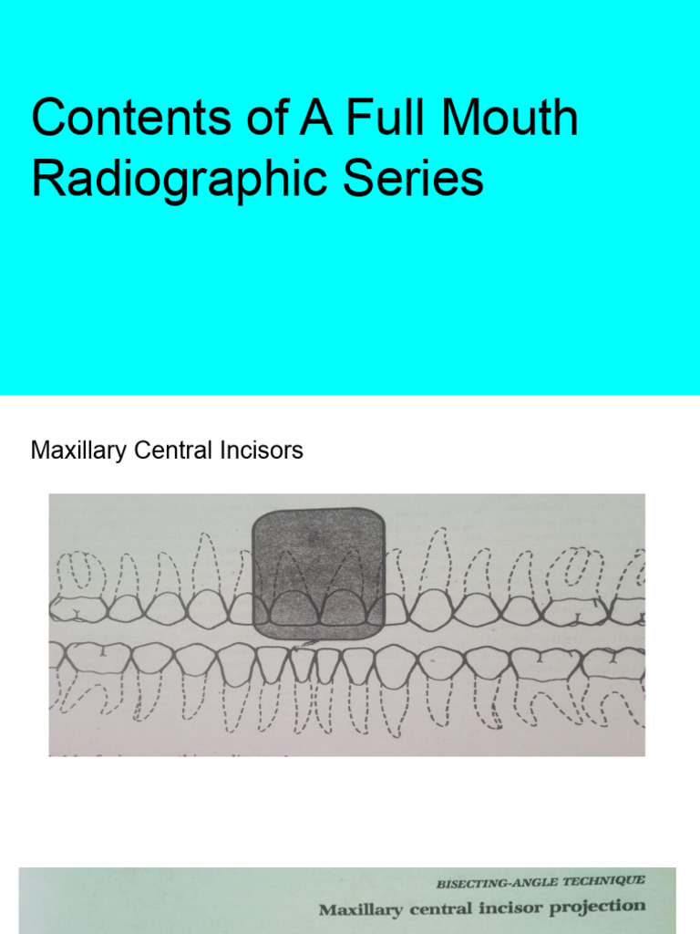 Contents of A Full Mouth Radiographic Series | PDF