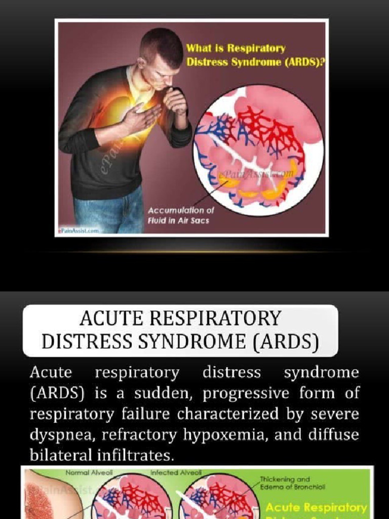Acute Respiratory Distress Syndrome | PDF