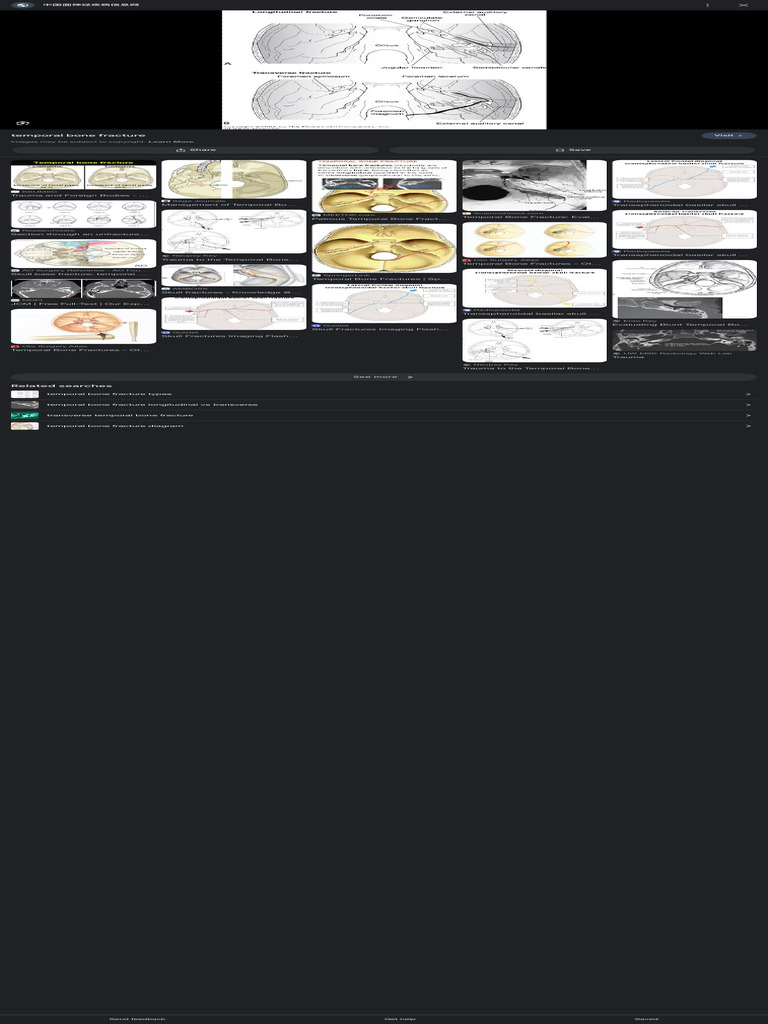 Searchq Longitudinal+Temporal+Bone+Fracture&Sca Esv 593541315&Rlz ...