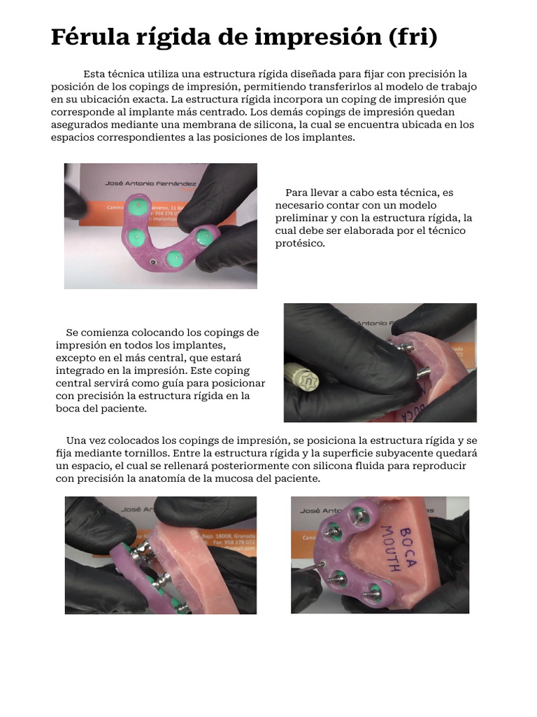 Férula Rígida de Impresión para Implantes | PDF