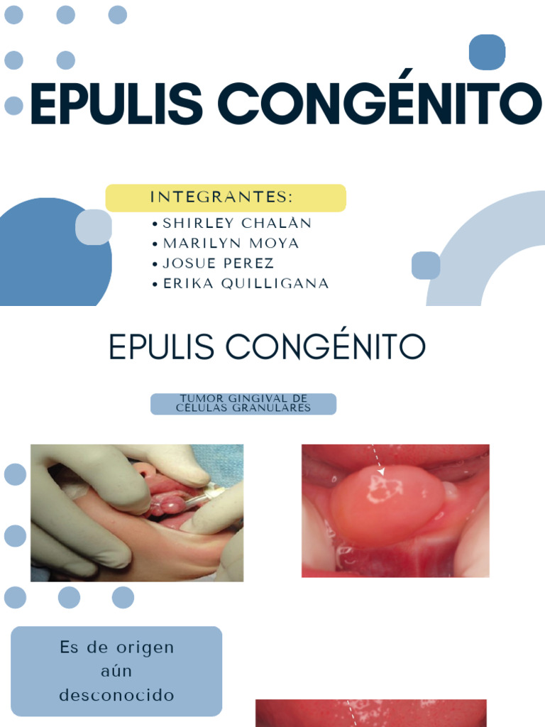 Épulis Congénito en Recién Nacidos | PDF | Neoplasias | Especialidades ...