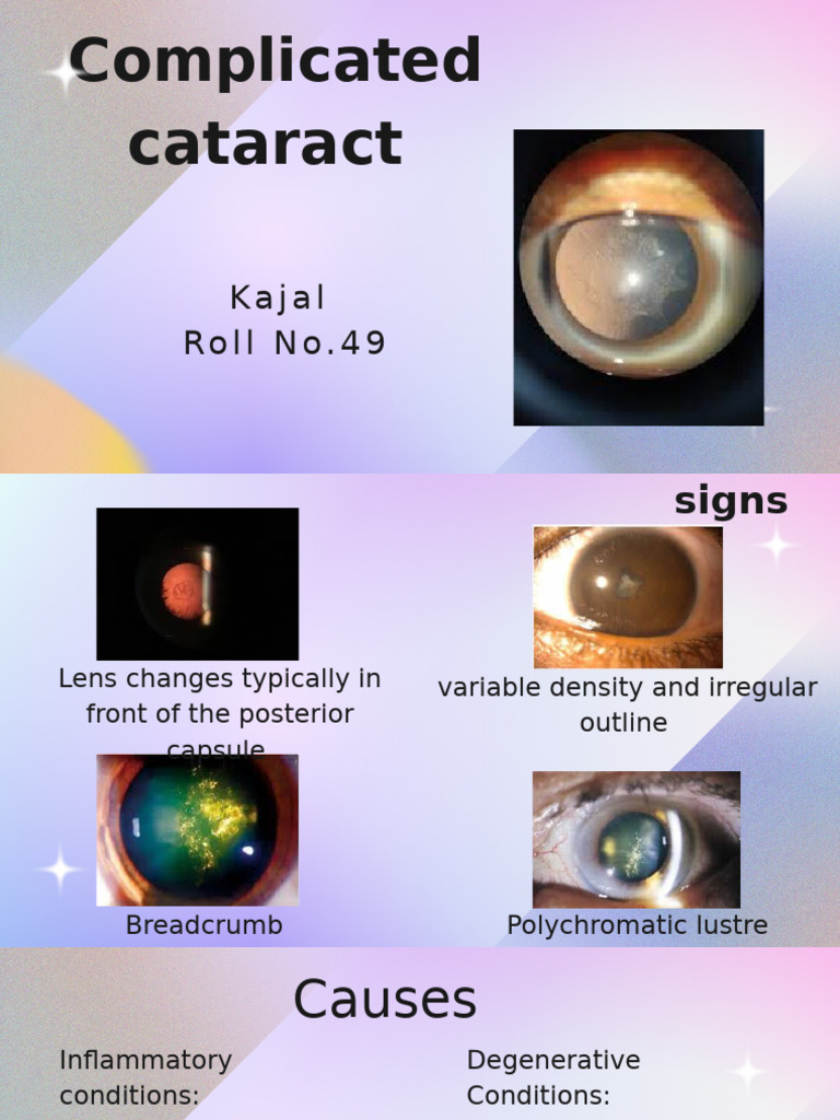 Complicated Cataract - 20250528 - 103201 - 0000 | PDF | Cataract | Glaucoma