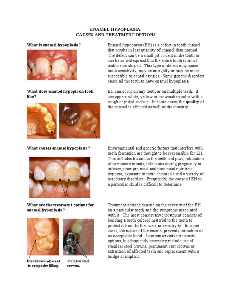 Enamel Hypoplasia Human Tooth Tooth Enamel