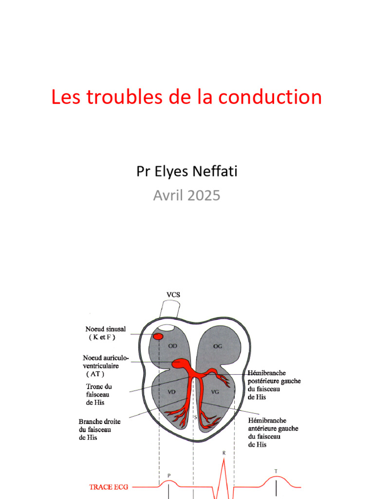 Troubles de conduction cardiaque | PDF | Électrocardiographie | Cardiologie