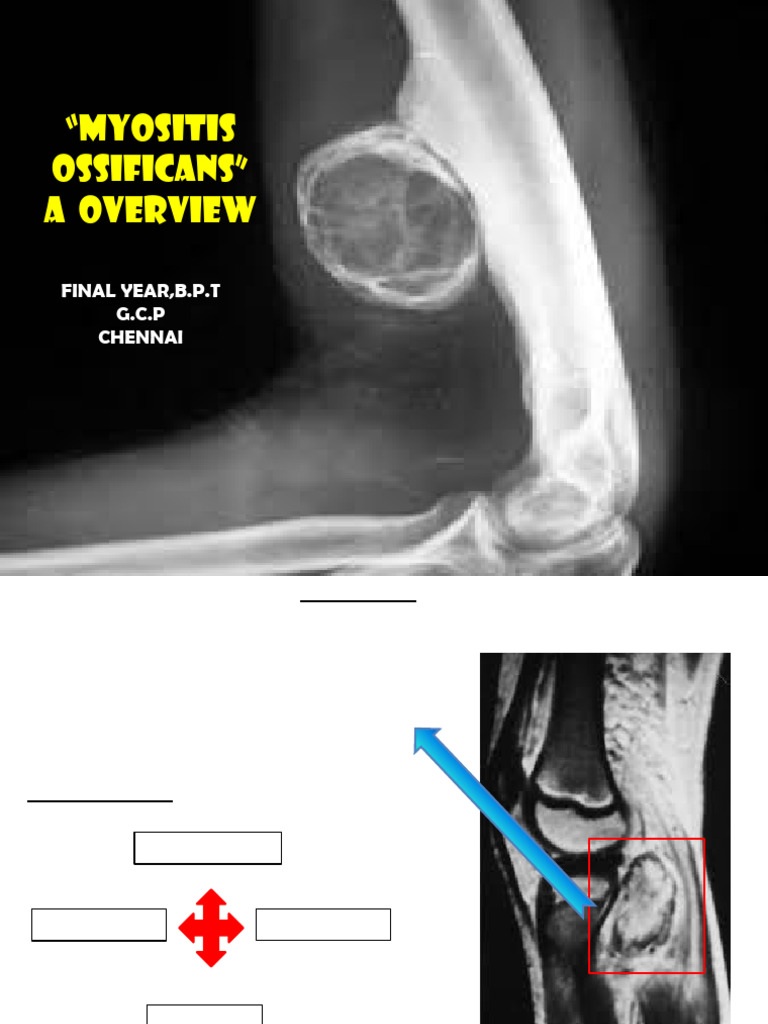 Myositis Ossificans Overview and Insights | PDF | Bone | Medical ...