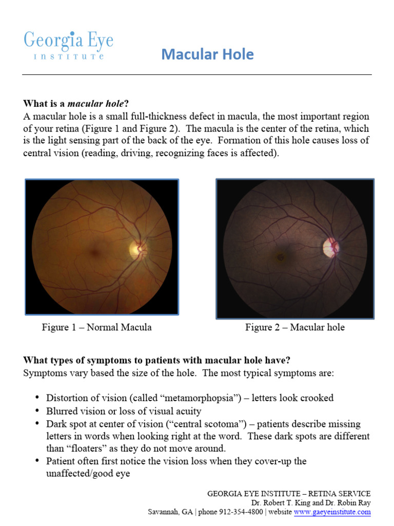 Understanding Macular Holes and Treatment | PDF | Senses | Clinical ...