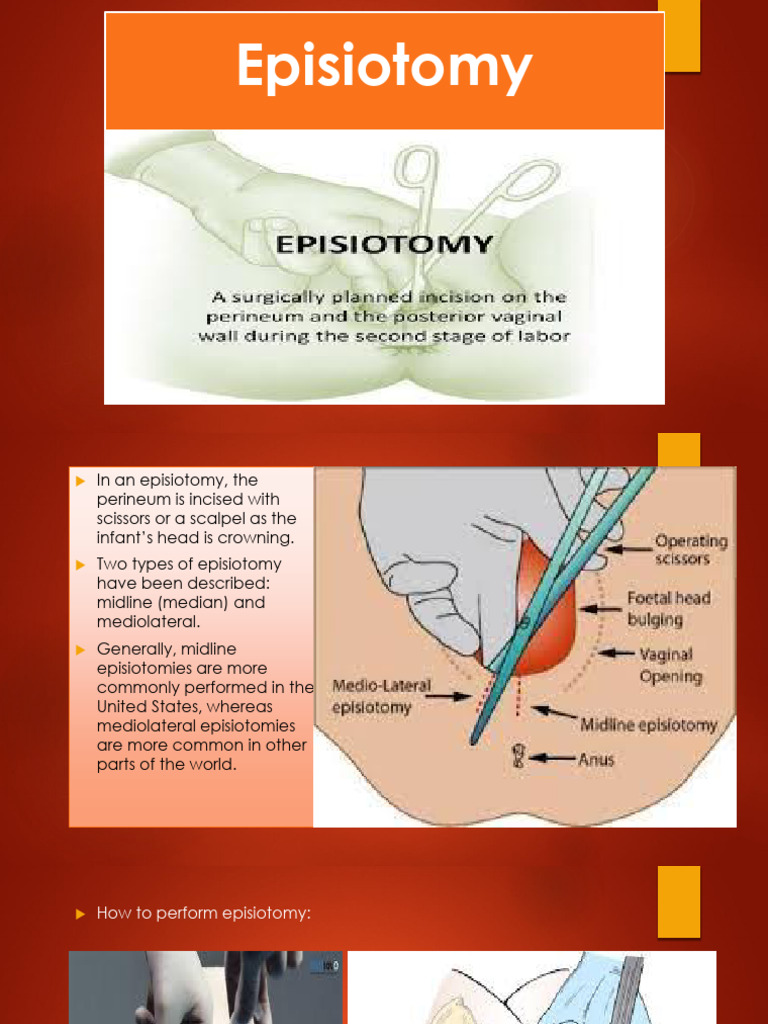 Understanding Episiotomy Techniques | PDF