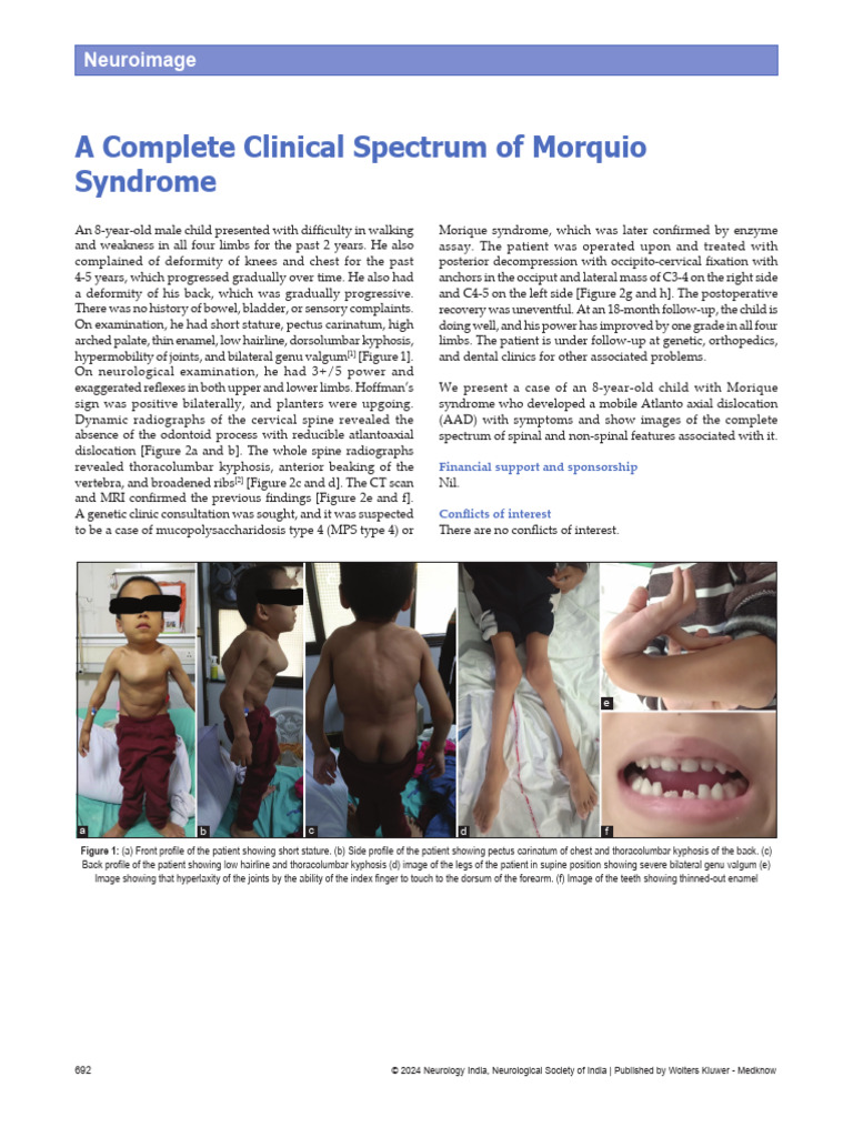 Clinical Features of Morquio Syndrome | PDF | Vertebral Column ...
