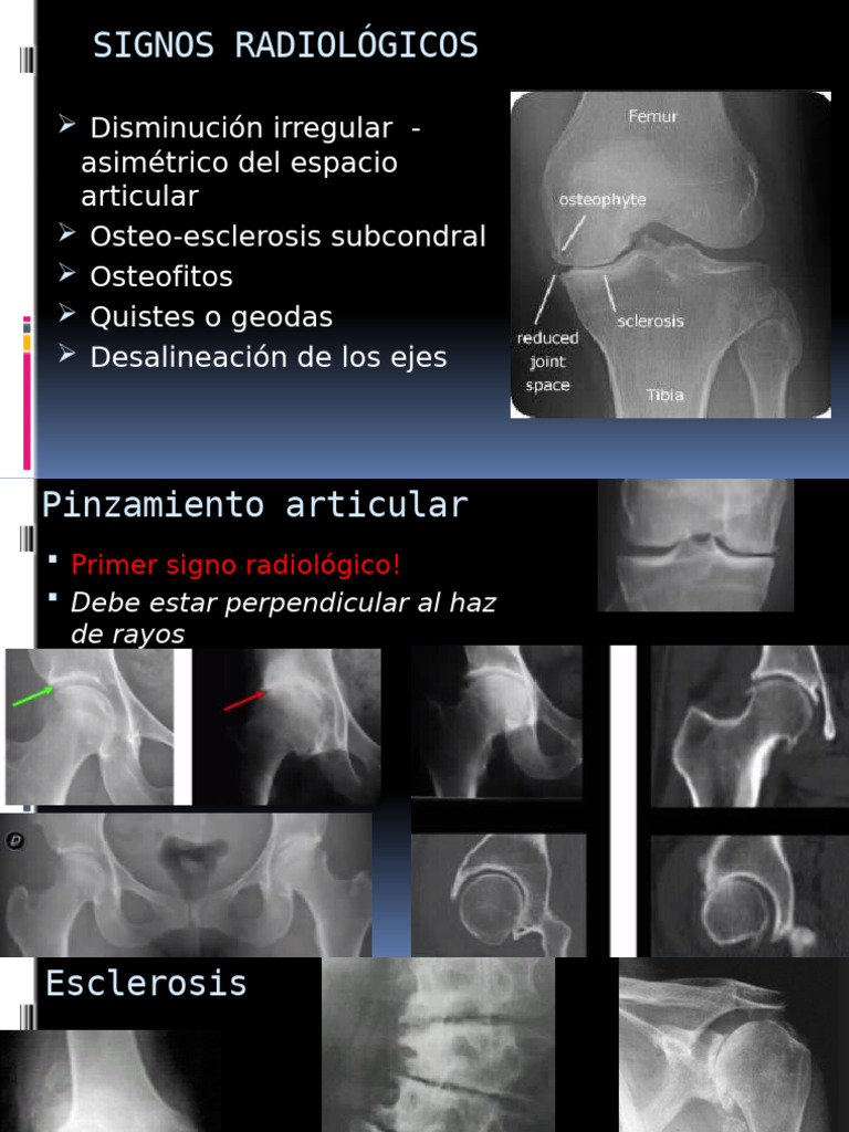 Signo de Romanus en Radiología Articular | PDF | Hueso | Osteoporosis