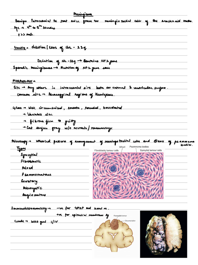 Meningioma | PDF