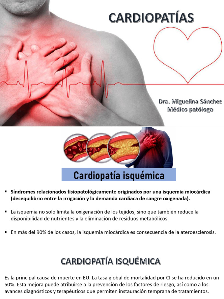 Tema 5 Cardiopatias (Isquémica, IAM, CH, CD) | PDF | Isquemia | Infarto ...