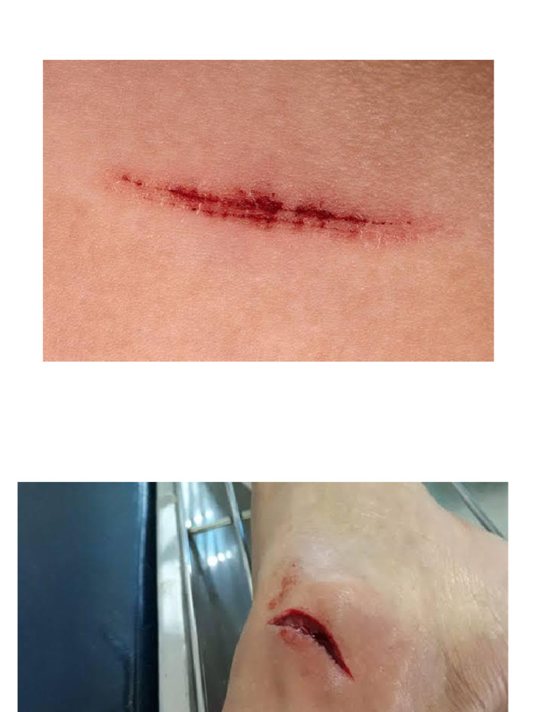 Types of Open Wounds Explained | PDF