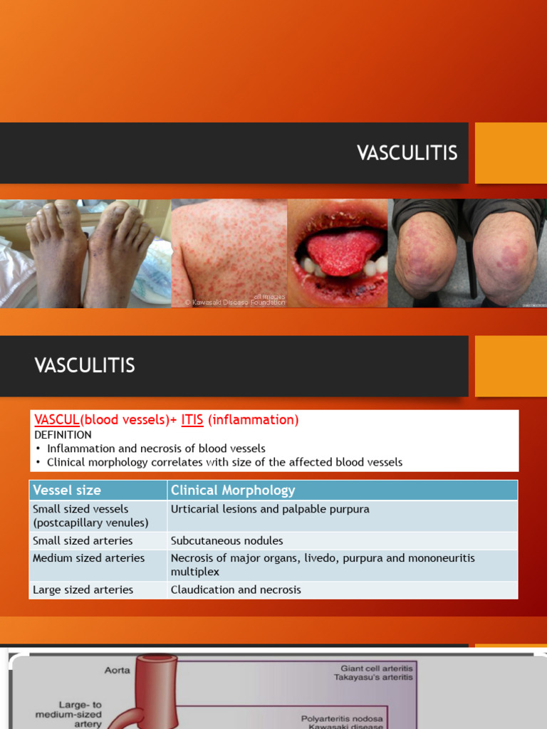 Vasculitis Part 2 (Autosaved) | PDF | Diseases And Disorders | Medical ...