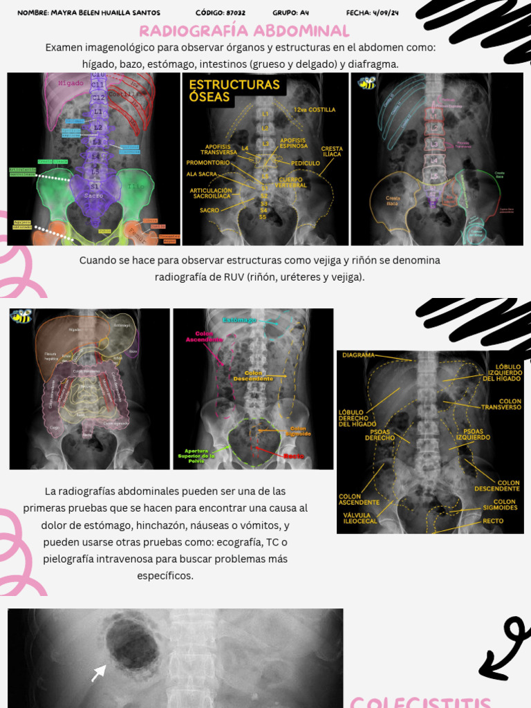 Radiografía Abdominal | PDF