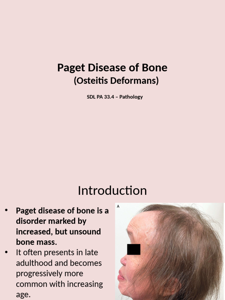 Paget - Disease - of - Bone - Presentation (1) (Autosaved) | PDF