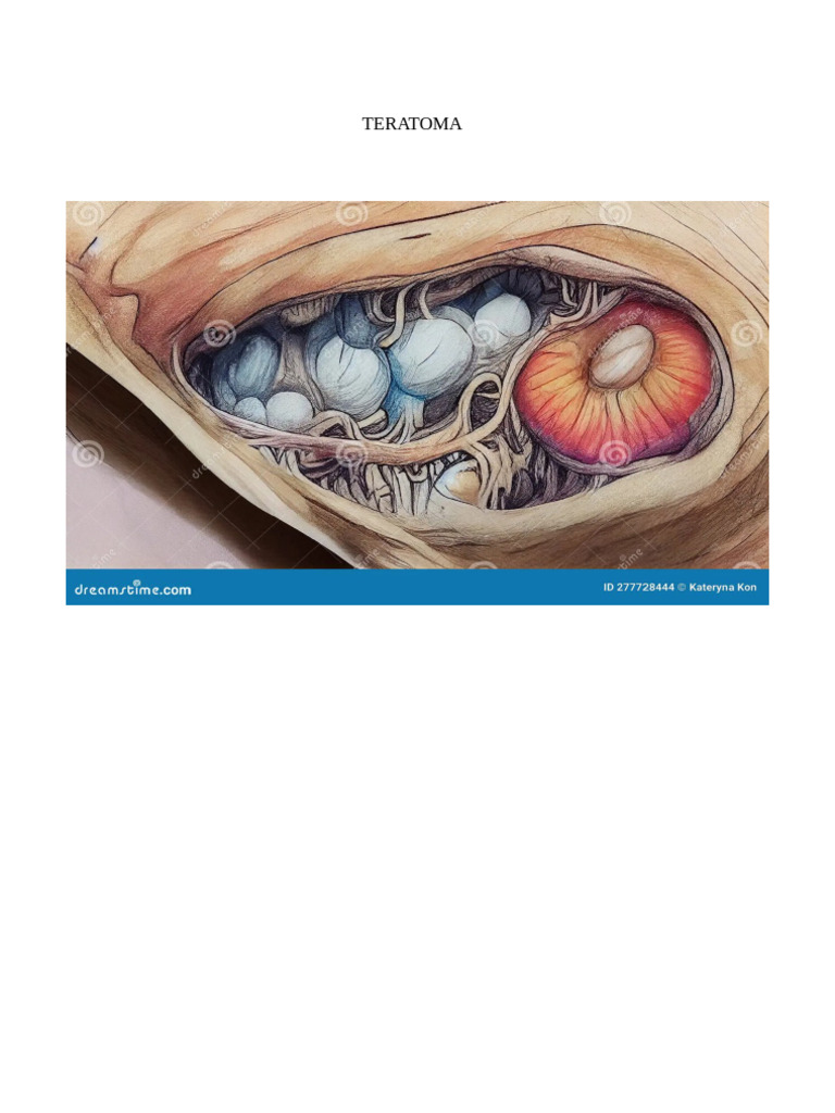 Teratoma Bio Thesisifinal | PDF