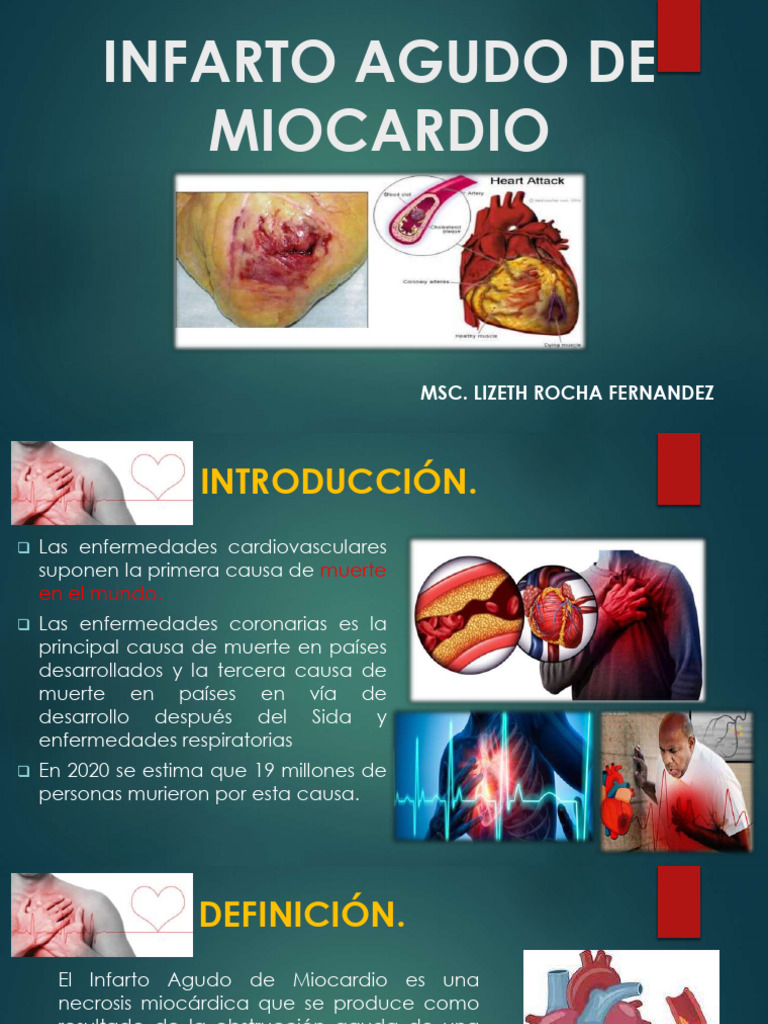 Infarto Agudo de Miocardio 1 | PDF | Infarto de miocardio | Isquemia