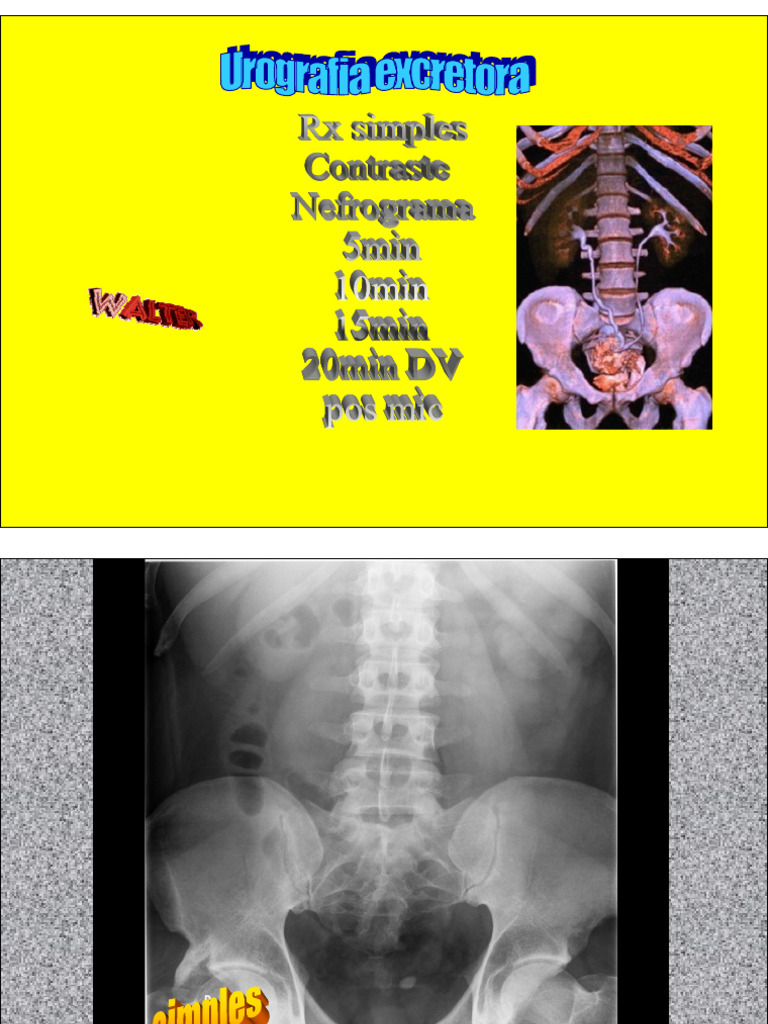 Urografia Walter | PDF