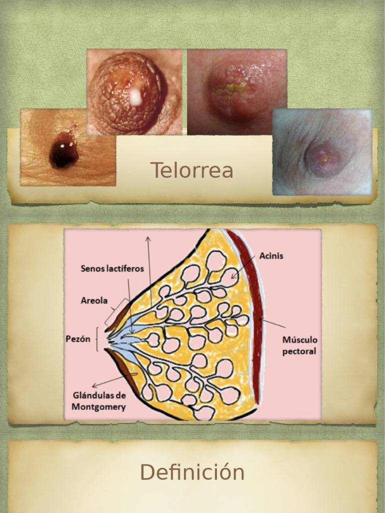 Telorrea: Tipos y Causas | PDF | Lactancia | Mamografía