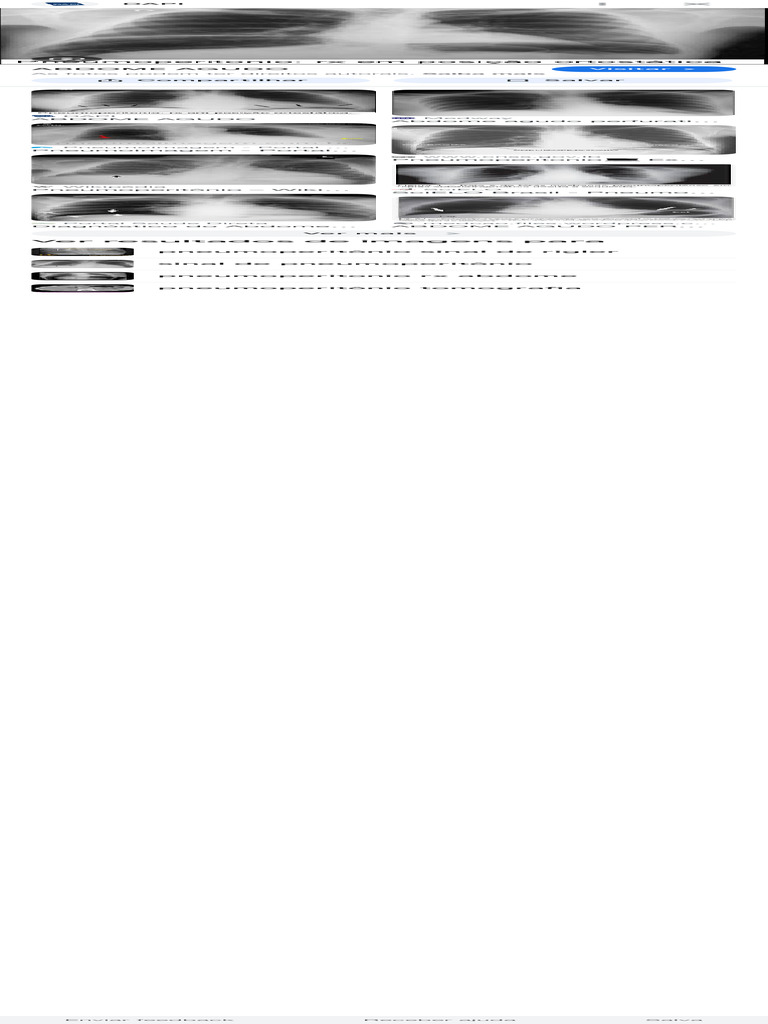 Sinal de Rigler em Pneumoperitônio | PDF