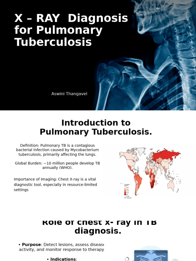 X-Ray Diagnosis of Pulmonary TB | PDF | Tuberculosis | Infection