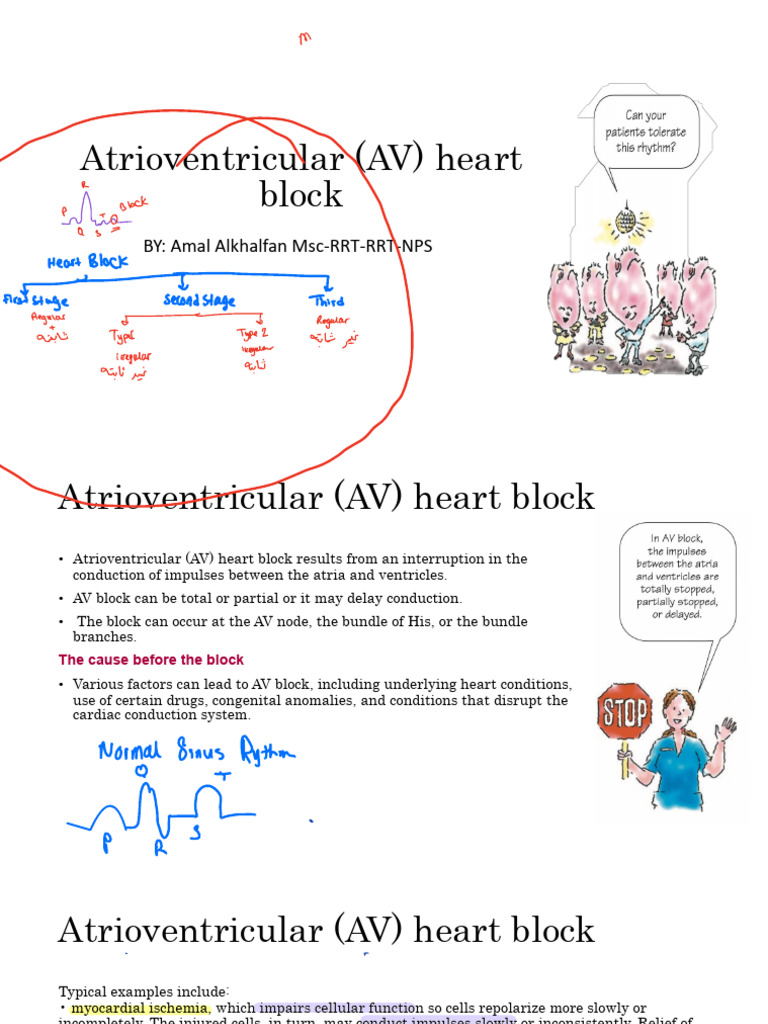 Atrioventricular AV Heart Block | PDF | Heart | Electrophysiology