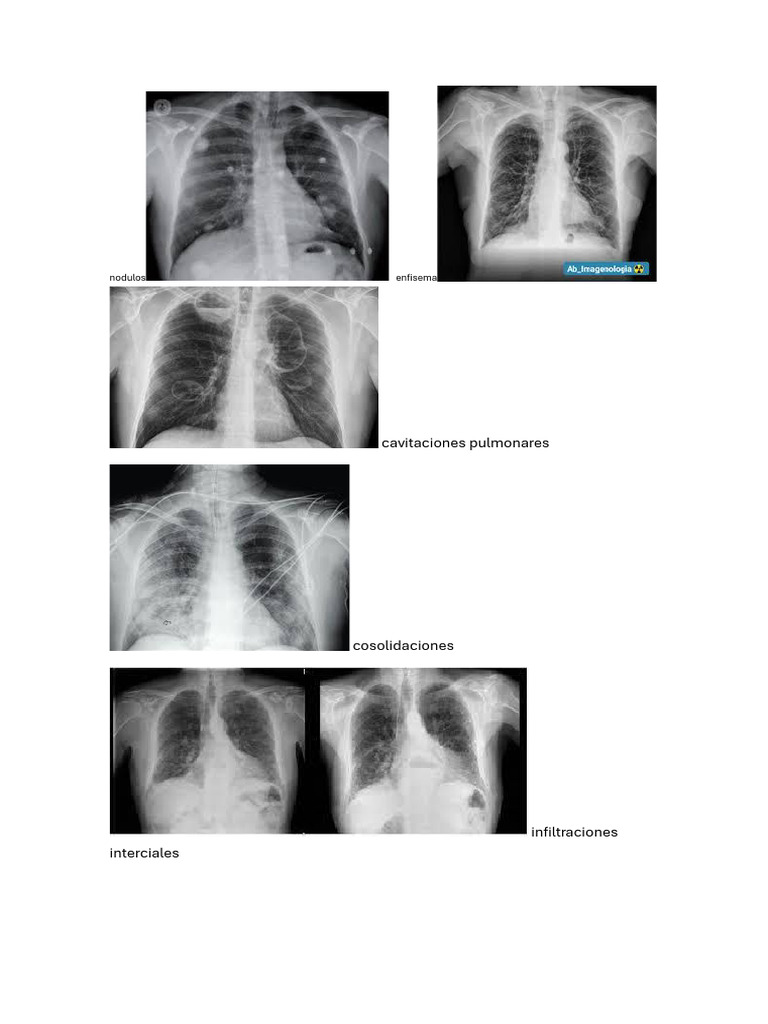 RX Pulmunar | PDF
