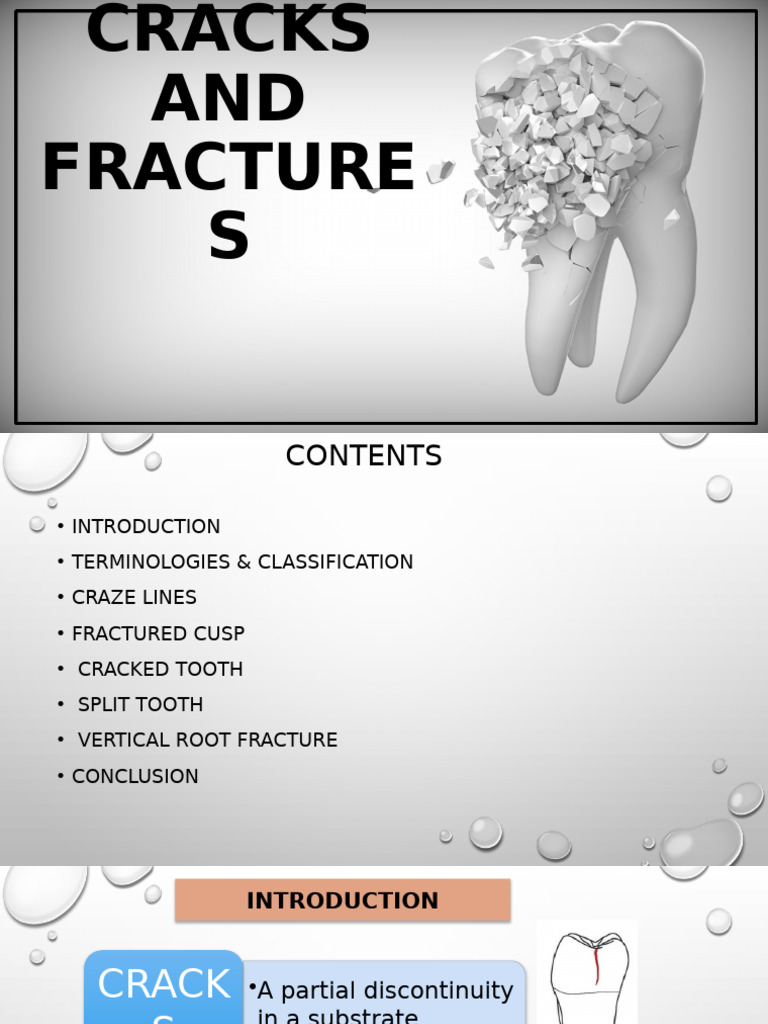 Understanding Tooth Cracks and Fractures | PDF | Dental Anatomy ...
