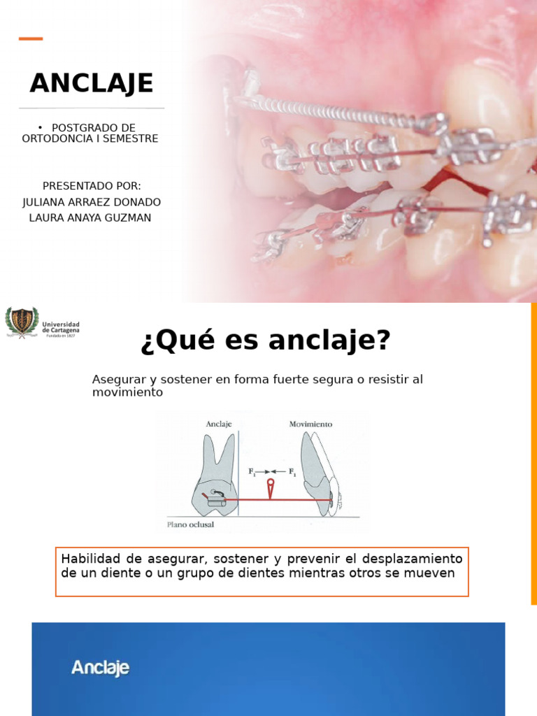 Anclaje Absoluto en Ortodoncia | PDF | Hueso | Tornillo
