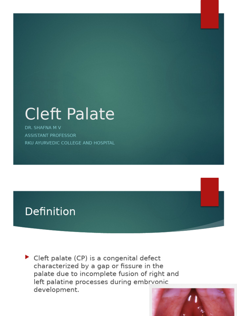 Cleft Palate Shafna-1 | PDF | Medical Specialties | Diseases And Disorders