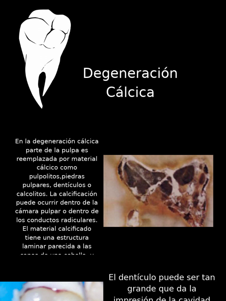 Degeneración Pulpar Calcificante | PDF | Diente | Enfermedades y trastornos