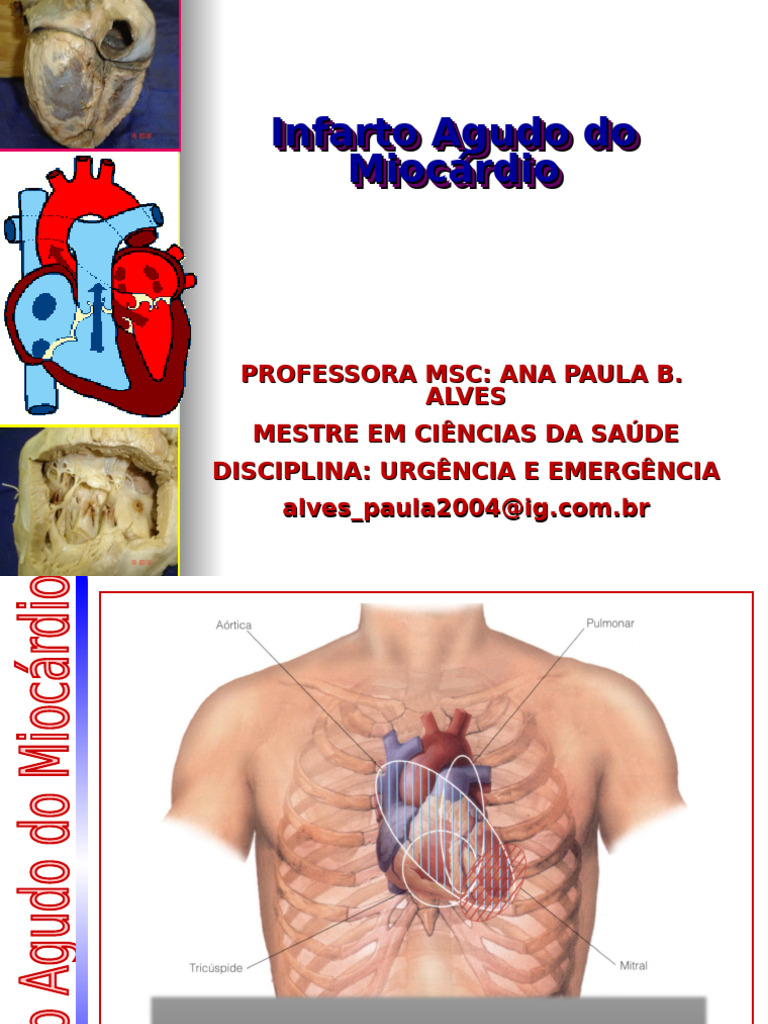 Infarto Agudo do Miocárdio: Sintomas e Tratamento | PDF | Infarto do ...