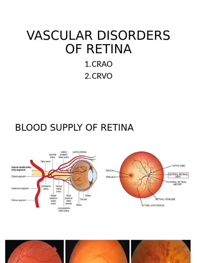 Vascular Disorders of Retina | PDF | Retina | Medical Specialties