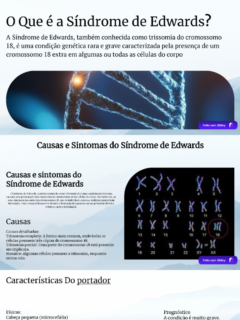 Síndrome de Edwards | PDF
