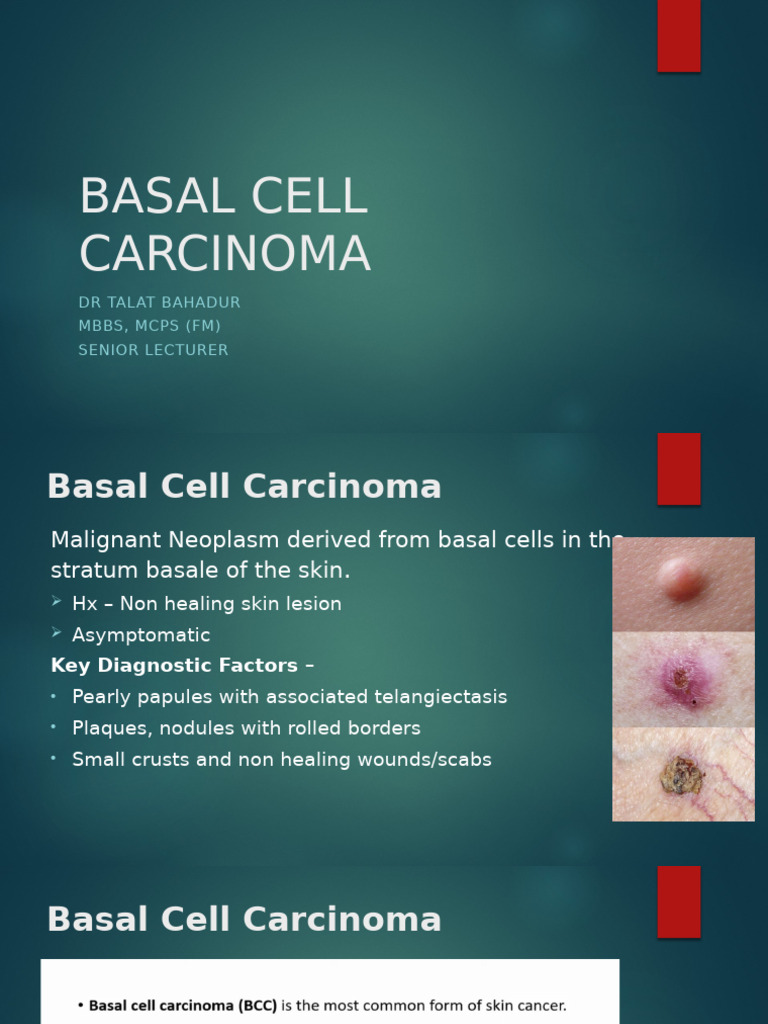 Understanding Basal Cell Carcinoma | PDF