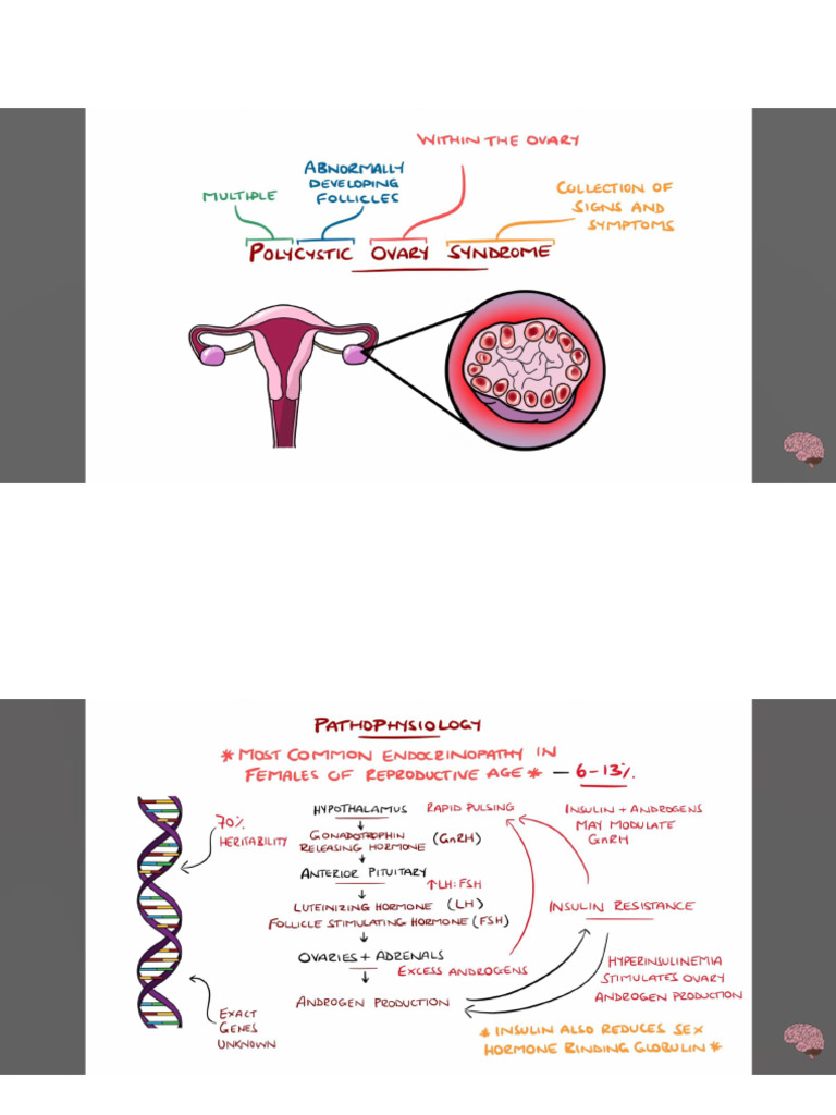 PCOS | PDF