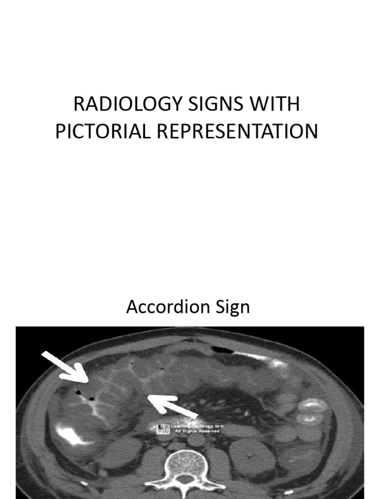 Key Radiology Signs Illustrated | PDF | Vertebral Column | Vertebra