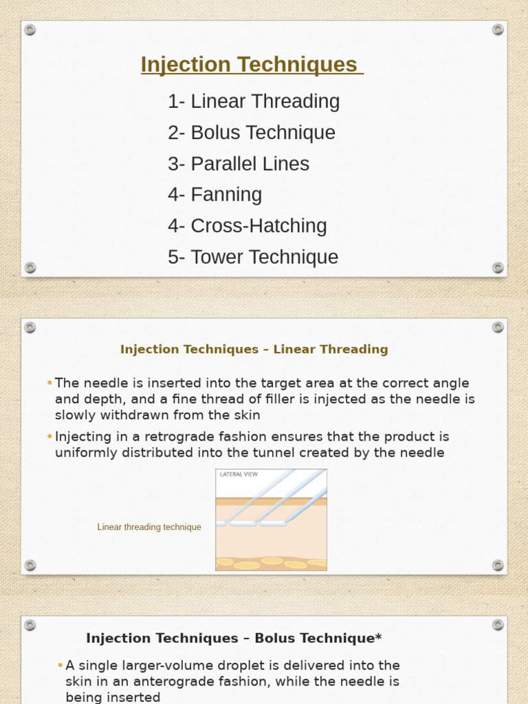 Neauvia Fileri Injection Techniques | PDF | Injection (Medicine)