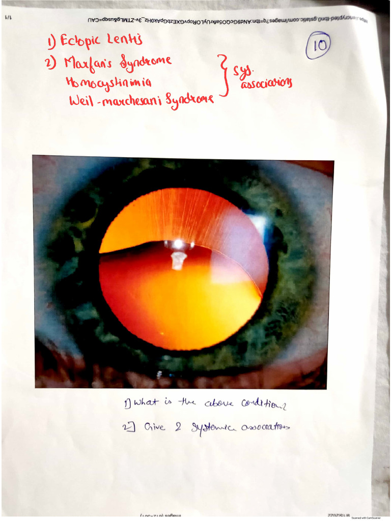 BJMC Ophth OSCE With Answers | PDF