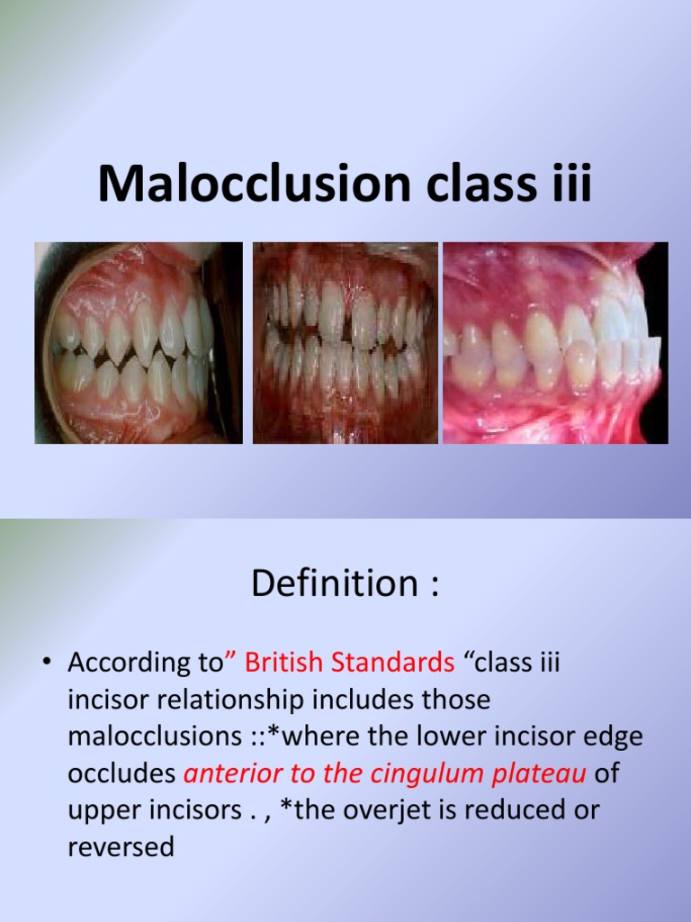 Malocclusion Class III Dental Anatomy Dentistry Branches