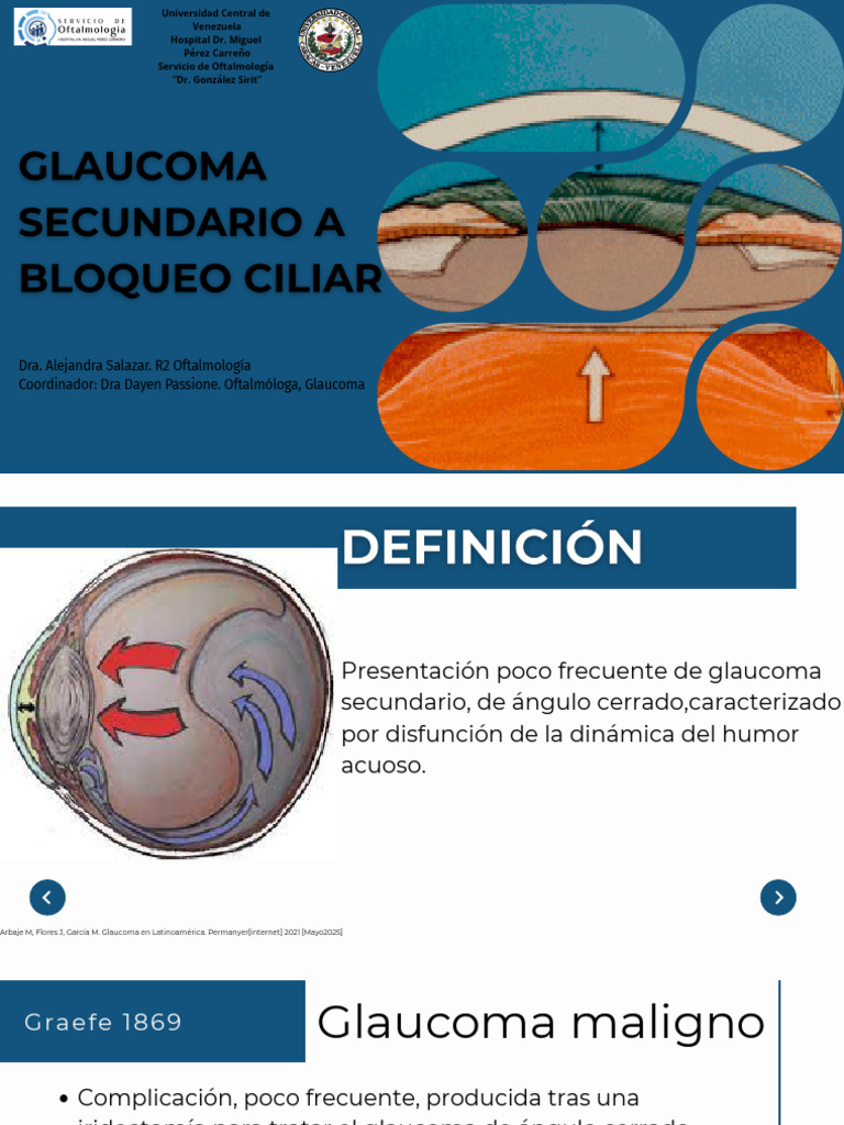 Glaucoma Maligno: Diagnóstico y Tratamiento | PDF | Glaucoma | Sentidos