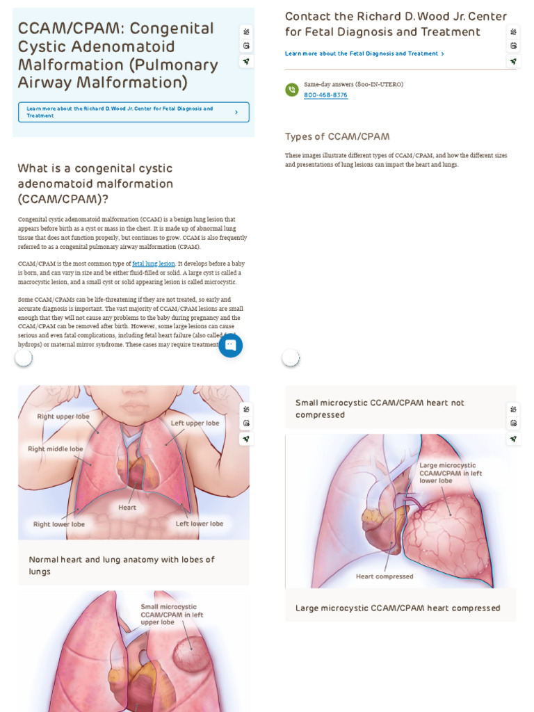 CCAM - CPAM - Congenital Cystic Adenomatoid Malformation (Pulmonary ...