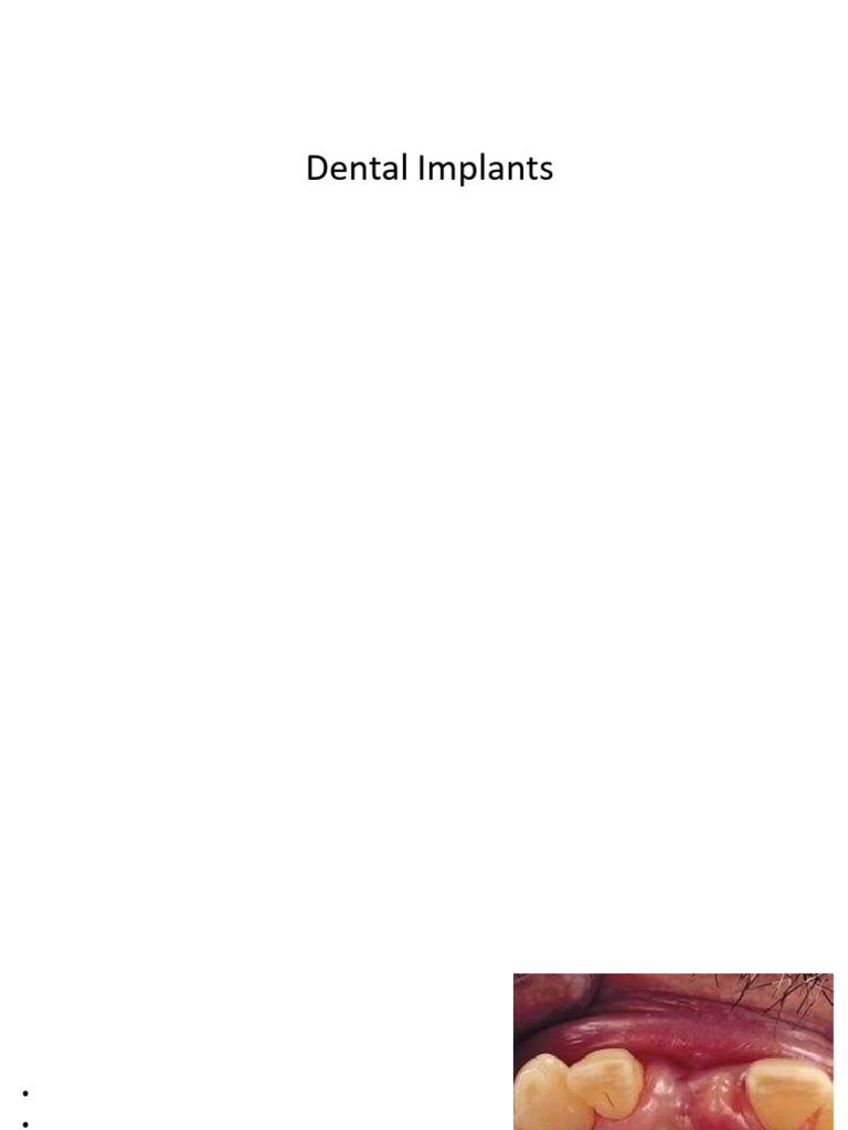 Implant L 2pdf - 250602 - 141400 | PDF | Dental Implant | Dentistry ...