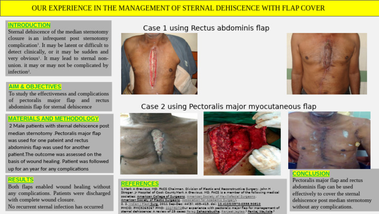 Flap Techniques for Sternal Dehiscence | PDF | Medical Procedures ...