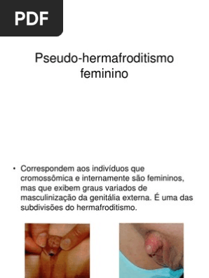 Featured image of post View 29 Pseudo Hermafroditismo Feminino Humano