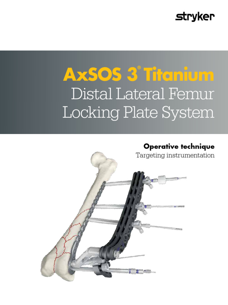 AxSOS 3 Distal Femur Locking Plate Guide | PDF | Screw | Electrical ...