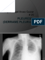 Pleuresia (Derrame Pleural)